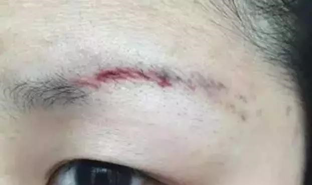 怎么让眉毛快速结痂掉痂,眉毛结痂掉痂修复过程