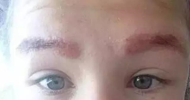 怎么让眉毛快速结痂掉痂,眉毛结痂掉痂修复过程