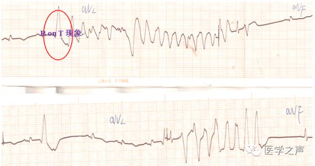 心电图速成视频讲座3,心电图的完整讲座视频