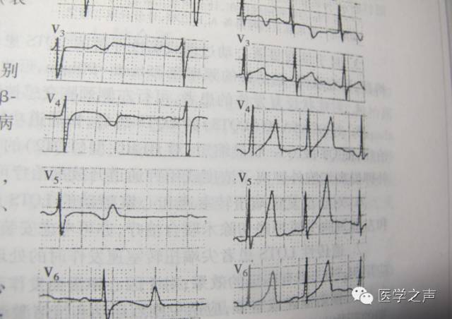 心电图显示t波高尖qt间期延长,心电图显示qt间期延长怎么回事