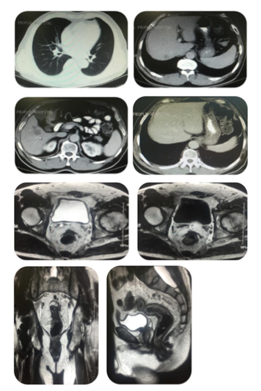 直肠癌肺转移多发治疗方案,直肠癌转移治愈病例