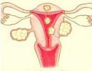 瘢痕子宫注意事项,瘢痕子宫厚2mm注意什么