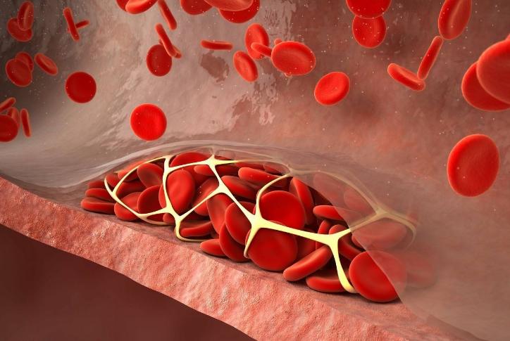 治血栓的民间配方最新,预防血栓食谱一览表