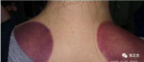 拔罐后皮肤颜色，反应出身体健康的不同问题