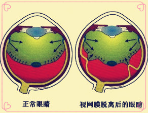 眼前有闪光感,眨眼的时候眼前有闪光感