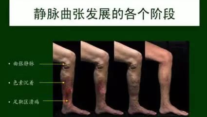 诺丽果有降血糖的作用吗,诺丽果十大健康功效