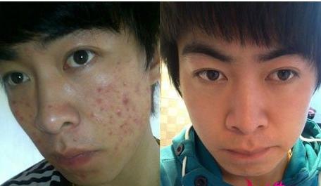 痘痘在哪几个地方不要挤掉,痘痘哪里不能挤