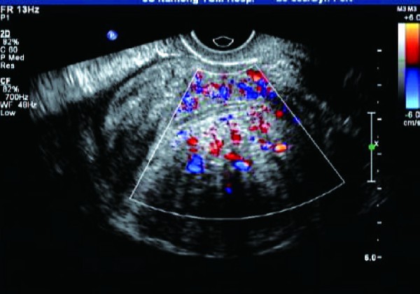 关于子宫内膜异位的病例,子宫内膜异位症者的症状
