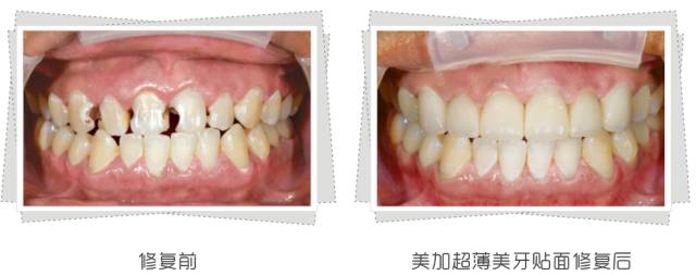 牙齿发黄让牙齿美白几个小妙招,牙齿不白笑容不好看