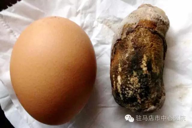 他吃了一顿虾，胆囊竟肿成“火龙果”！只因为这种常见病