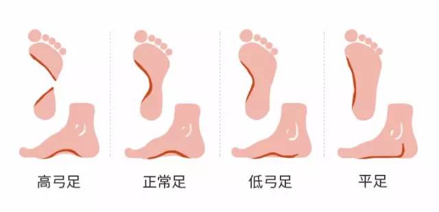 扁平足需要垫足弓吗,扁平足足弓套有用吗