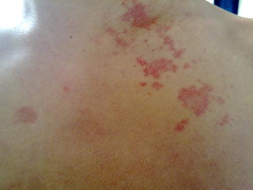 妙治汗斑的实用配方