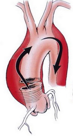 美国治疗主动脉夹层,倪海厦治疗主动脉夹层