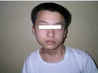 宝宝斜颈过度干预歪得更厉害,痉挛性斜颈的严重危害千万别忽视