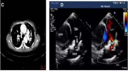 主动脉夹层动脉瘤如何检查和防治,主动脉夹层动脉瘤的超声表现