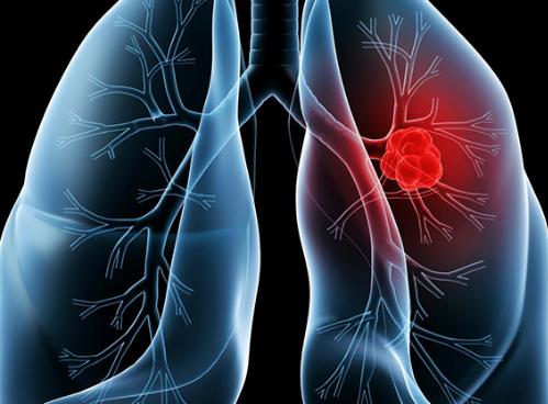 肺癌早期身体有哪些信号？这七大信号是在提醒我们吗？