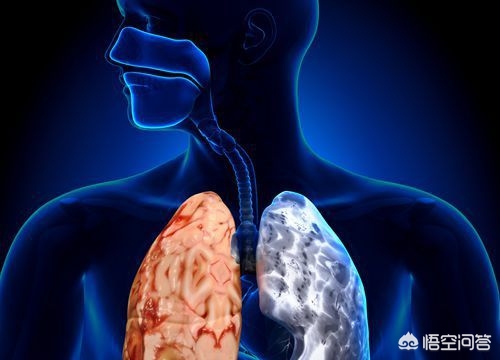 如何发现肺结核常见症状有哪些,肺结核最常见的症状是什么