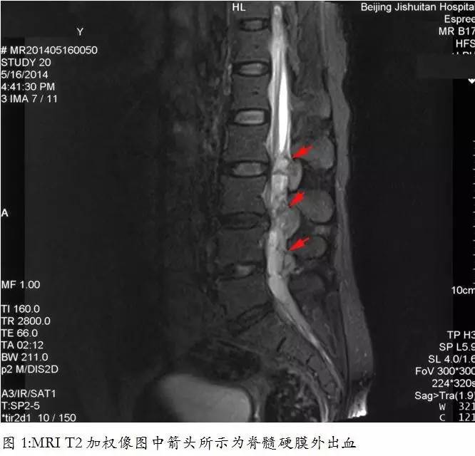 服用华法林后突发双下肢疼痛，原因竟是？