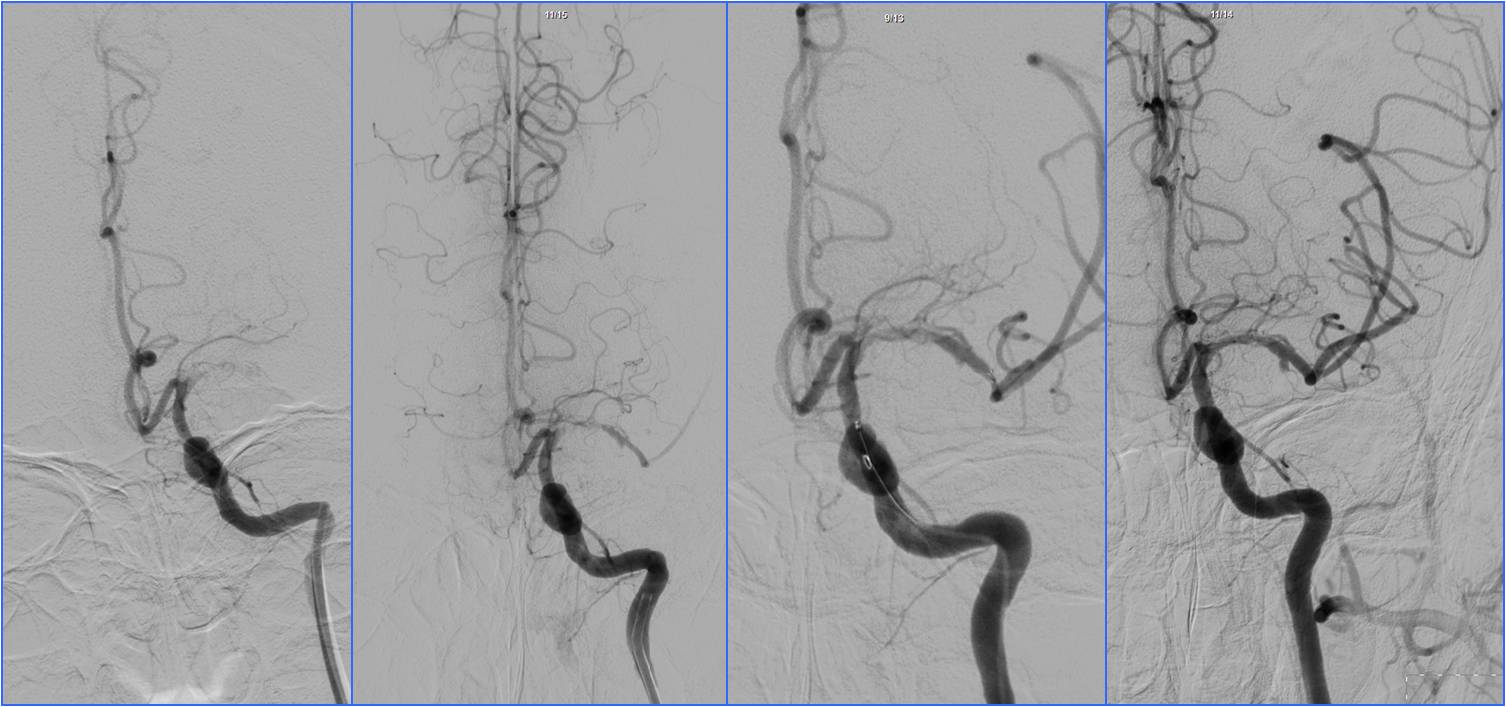 缺血性脑卒中术后管理,急性缺血性脑卒中血管内治疗