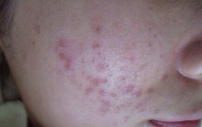 痘痘一长就不容易消灭,痘痘一长就红肿挤不出东西怎么办