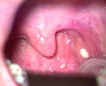 口臭喉咙有痰看哪一科,口臭喉咙经常咳出一坨东西怎样治