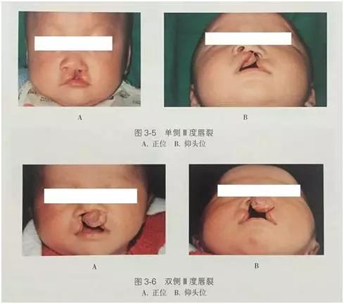 胎儿唇腭裂的原因,唇腭裂影响说话吗