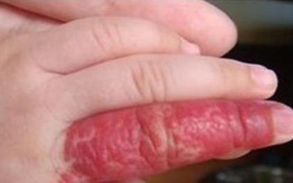 海绵状血管瘤饮食注意事项,海绵状血管瘤注意饮食