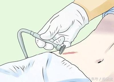 疤痕修复包括痘疤,刀疤跟痘疤哪种恢复快