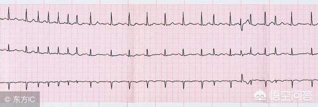 房颤患者需要做手术治疗吗,房颤可以药物控制吗