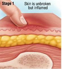 褥疮的护理和治疗方法,褥疮最怕的克星