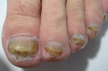 灰指甲的病因、症状及危害，颜色不是唯一的诊断标准！