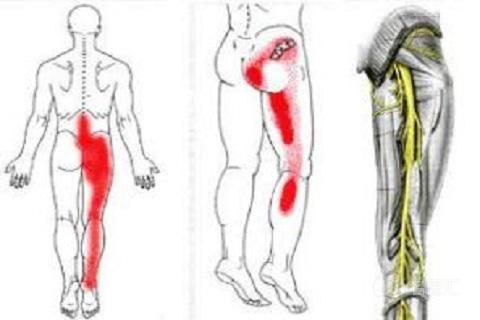 坐骨神经痛的治疗,坐骨神经痛的治疗器械