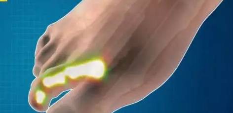 从脚看出疾病征兆,脚型不好看是怎么回事