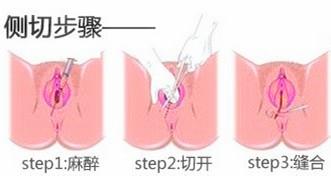 出现哪些情况，孕妇顺产时需要侧切，以及侧切的全步骤