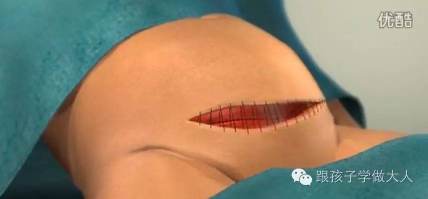 一些关于剖腹产的细节你知道多少,剖腹产最难的一个步骤