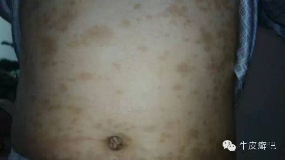 医院专家教你治疗牛皮癣,专家专治牛皮癣方法