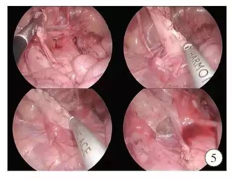 手术演示肠造口术后单切口腹腔镜辅助巨结肠根治术（Duhame1术）