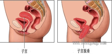 女性在什么情况下要切除子宫,女人在什么情况下要切子宫