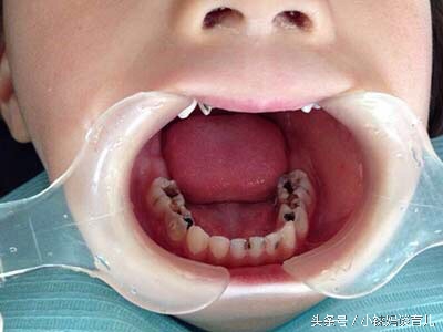 乳牙掉了没牙根怎么补牙,儿童乳牙龋齿烂了有必要补牙吗