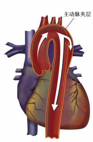 妊娠主动脉夹层的症状,妊娠高血压与主动脉夹层