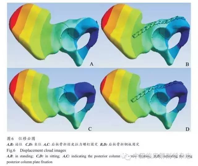 长骨骨折石膏固定术,长骨骨折夹板固定