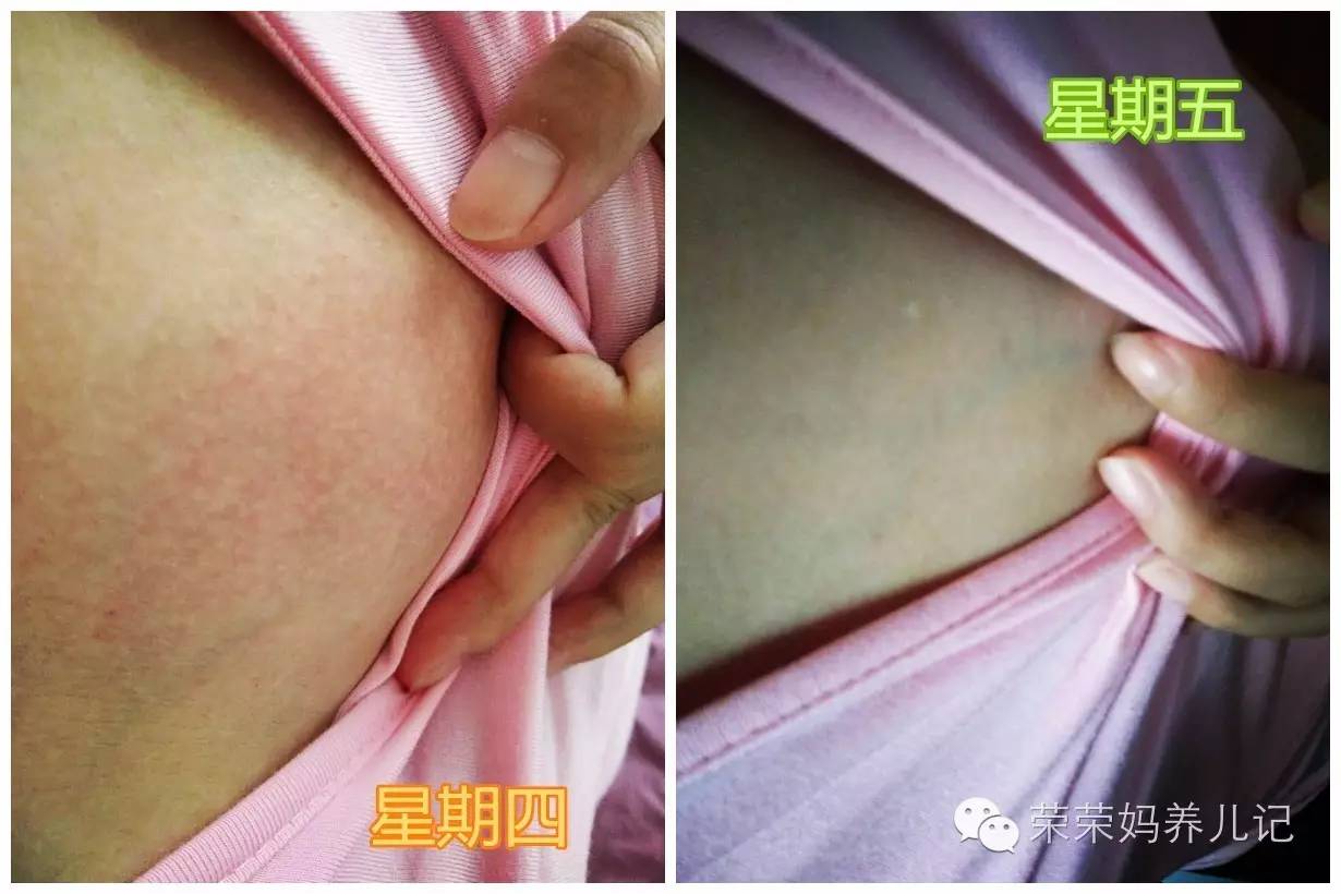 急性乳腺炎怎么按摩通奶教程,乳腺炎最佳自救方法