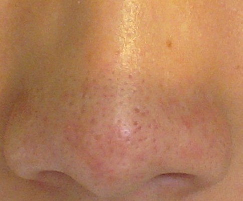 鼻子黑头毛孔粗大小方法解决,鼻子黑头毛孔粗大的改善方法