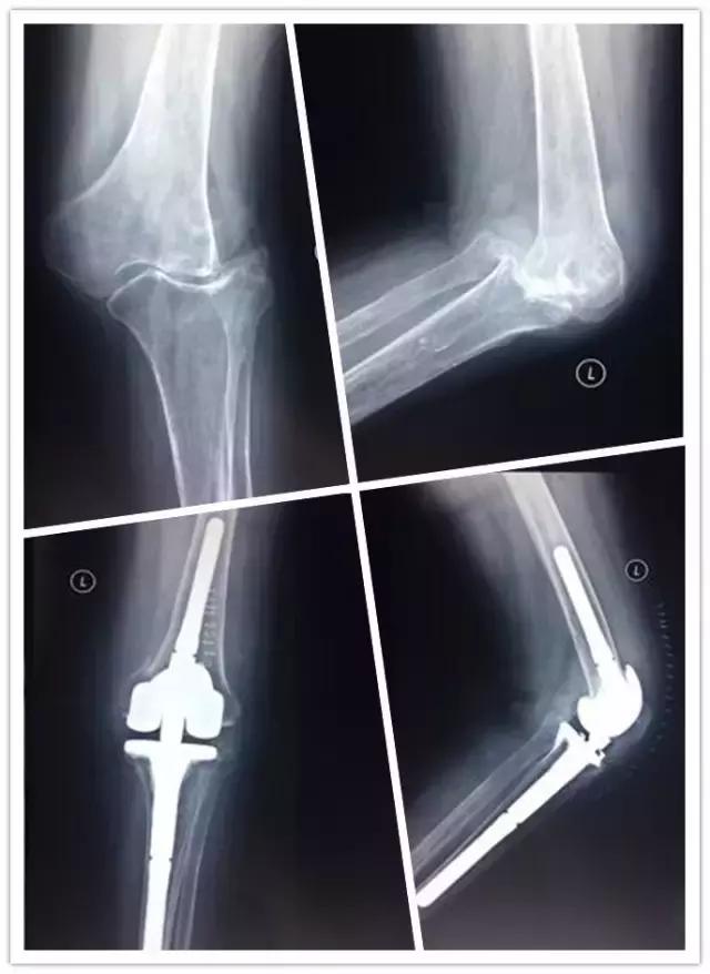 3d打印膝关节置换术效果好吗,膝关节置换3d打印图片