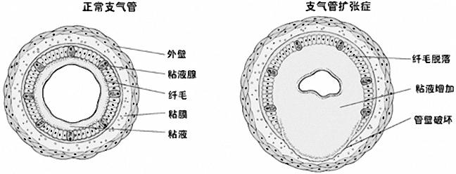 支气管扩张最有诊断价值的检查是,什么是支气管扩张和哮喘