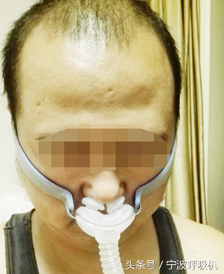 瑞思迈呼吸机面罩,瑞思迈airsense10呼吸机鼻罩