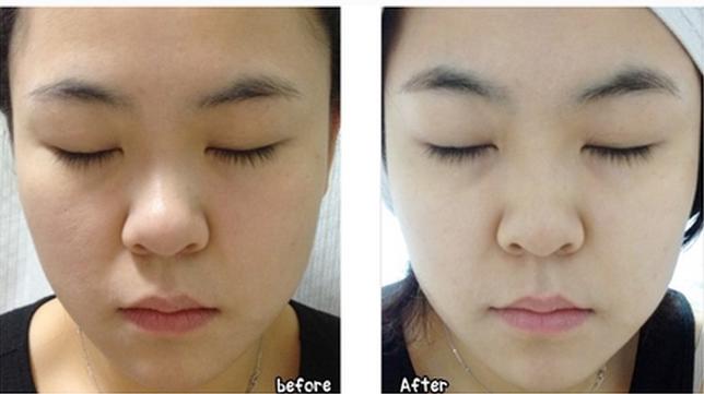 美白针没一点效果怎么样,美白针到底多久能见效呢