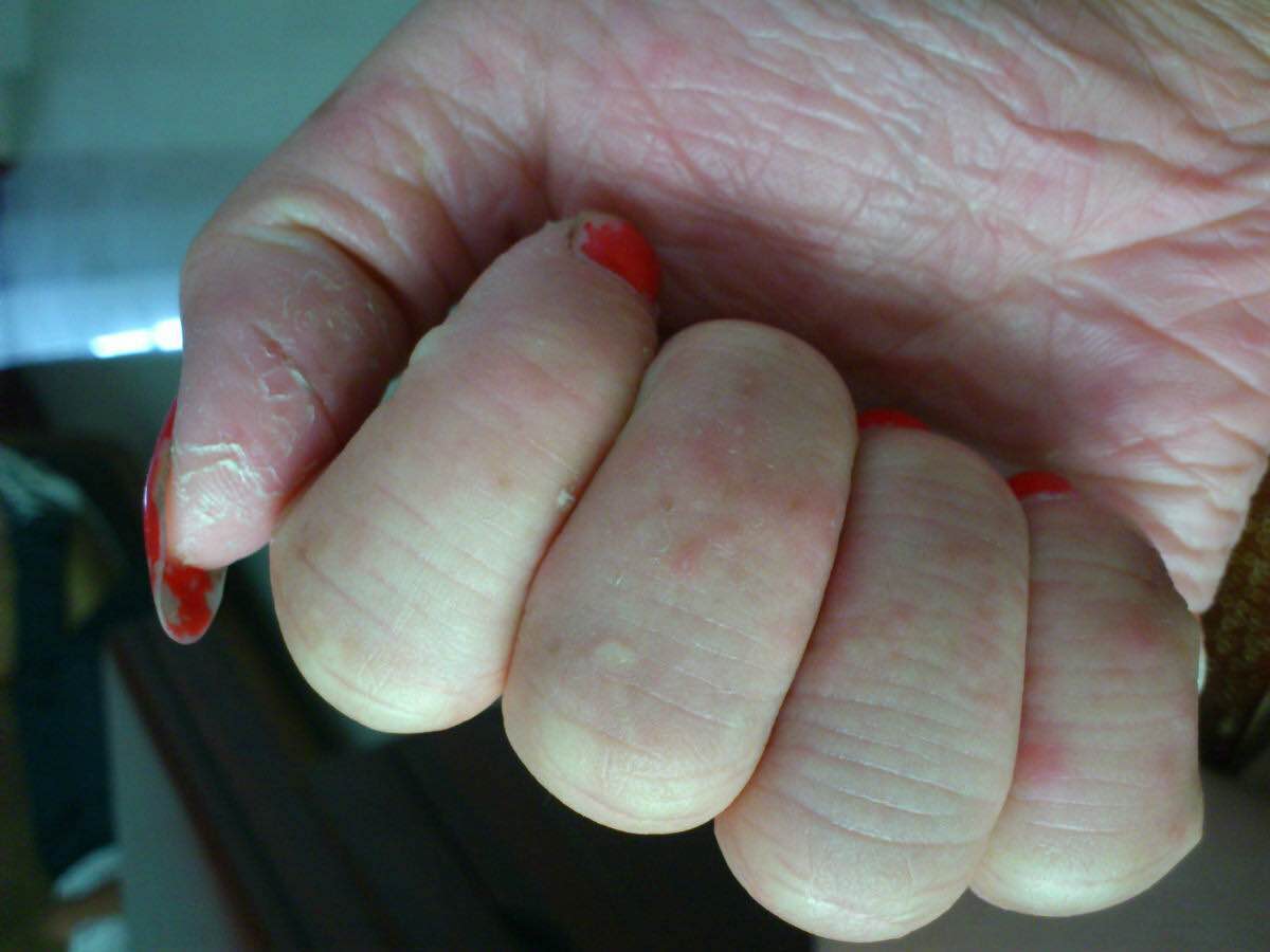 手上奇痒无比的小水泡,手上起小水泡痒用什么药