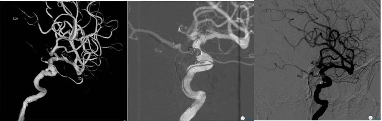 床突旁动脉瘤的血管内治疗