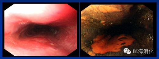 食管高级别上皮内瘤变选择治疗流程